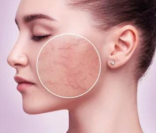 Rozacee – tratament laser Vbeam Perfecta si GentleMaxPro la DermaLife