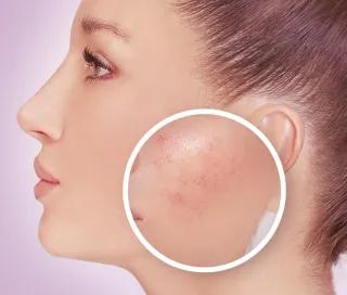 Tratamentul leziunilor vasculare cu Gentle Max Pro la DermaLife