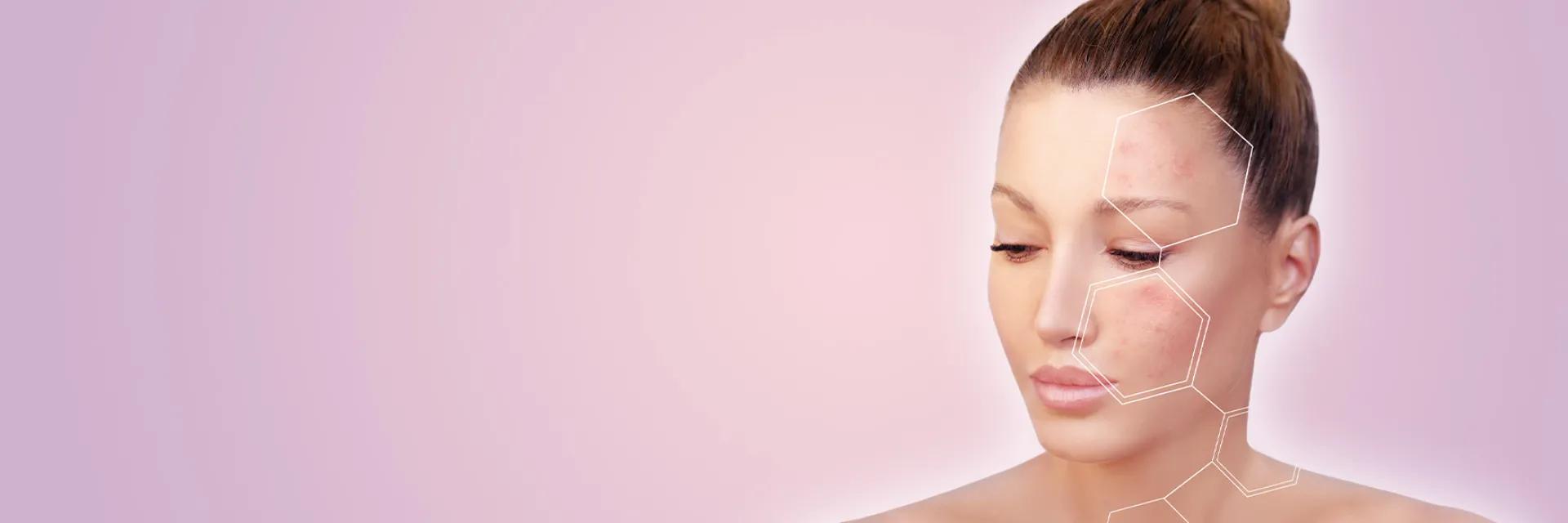 Melasma si tratamentul leziunilor pigmentare la DermaLife