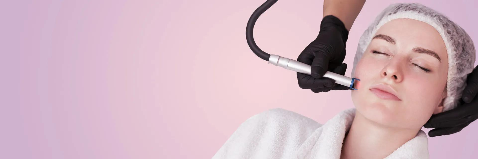 Tratare venectazii vase sparte cu Laser Pulsat PERFECTA la DermaLife